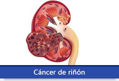 cancer_riñon