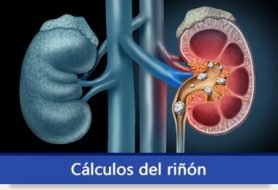 calculos_riñon